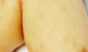 patient with eczema before and after treatment