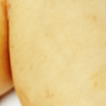 Picture of hand dermatitis (eczema on hand)