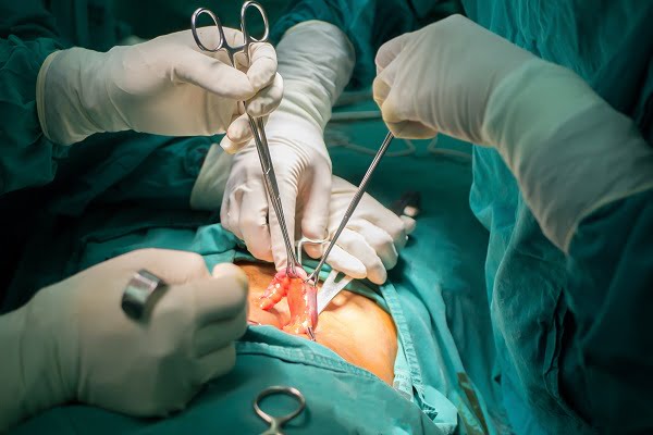 What You Should Know About Appendectomy?