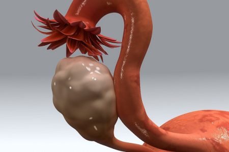 Glossary for Endometrial Cancer