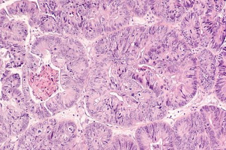 Stage 4 Endometrial Cancer and Its Treatment