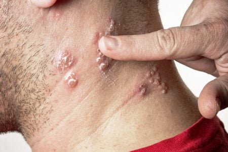What Does Shingles Look Like?