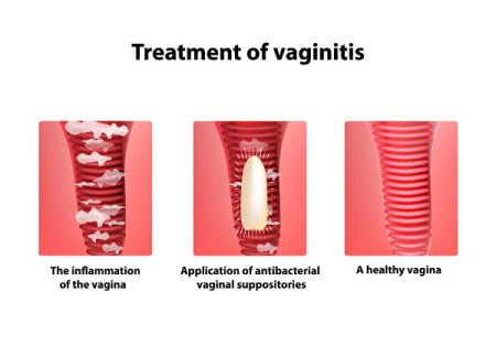 Treating Different Types of Vaginitis