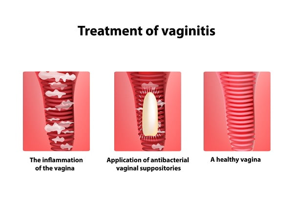 Treating Different Types of Vaginitis