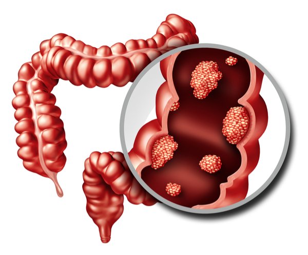 What are the Symptoms of Colorectal Cancer?