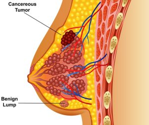 Illustration of cancerous breast tumor