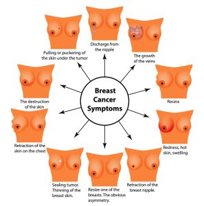 Breast cancer signs and symptoms