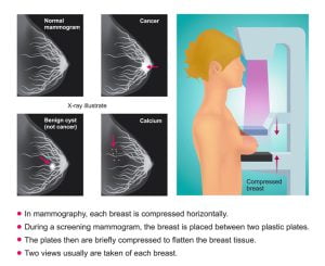 Screening mammography image