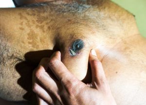 Male Breast Cancer
