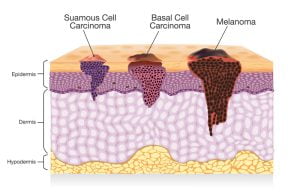 Types of skin cancer