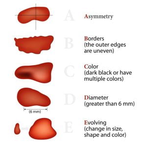 ABCDE Rule for the early detection of Melanoma