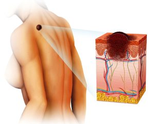 Skin Cancer Image