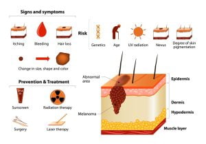 Signs, Symptoms, Prevention, Treatment of Melanoma