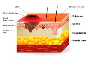 Squamous-cell carcinoma or squamous cell cancer