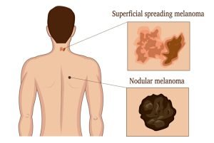 Types of Melanoma