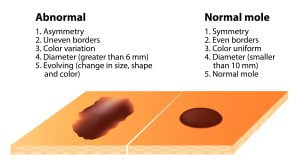 Signs and symptoms of skin cancer