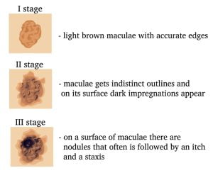 Stages of transformation of Malignant Lentigo in the Melanoma