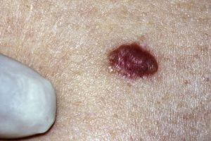Basal cell carcinoma on the skin of a patient