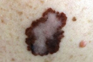 Melanoma on the skin of a patient
