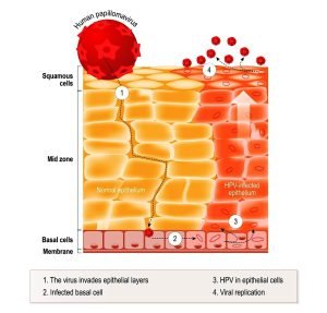 Human papilloma virus (HPV) infection and skin cancer