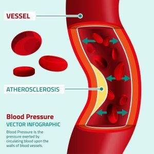 Blood pressure (BP) is the pressure of circulating blood on the walls of blood vessels