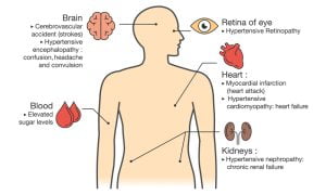 Complications of hypertension