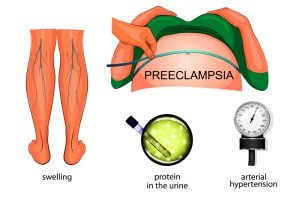 Hypertension and Preeclampsia