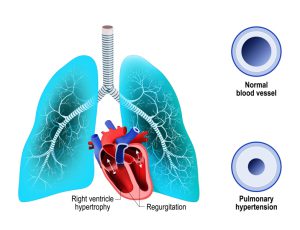 Pulmonary hypertension image