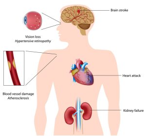 Complications of hypertension