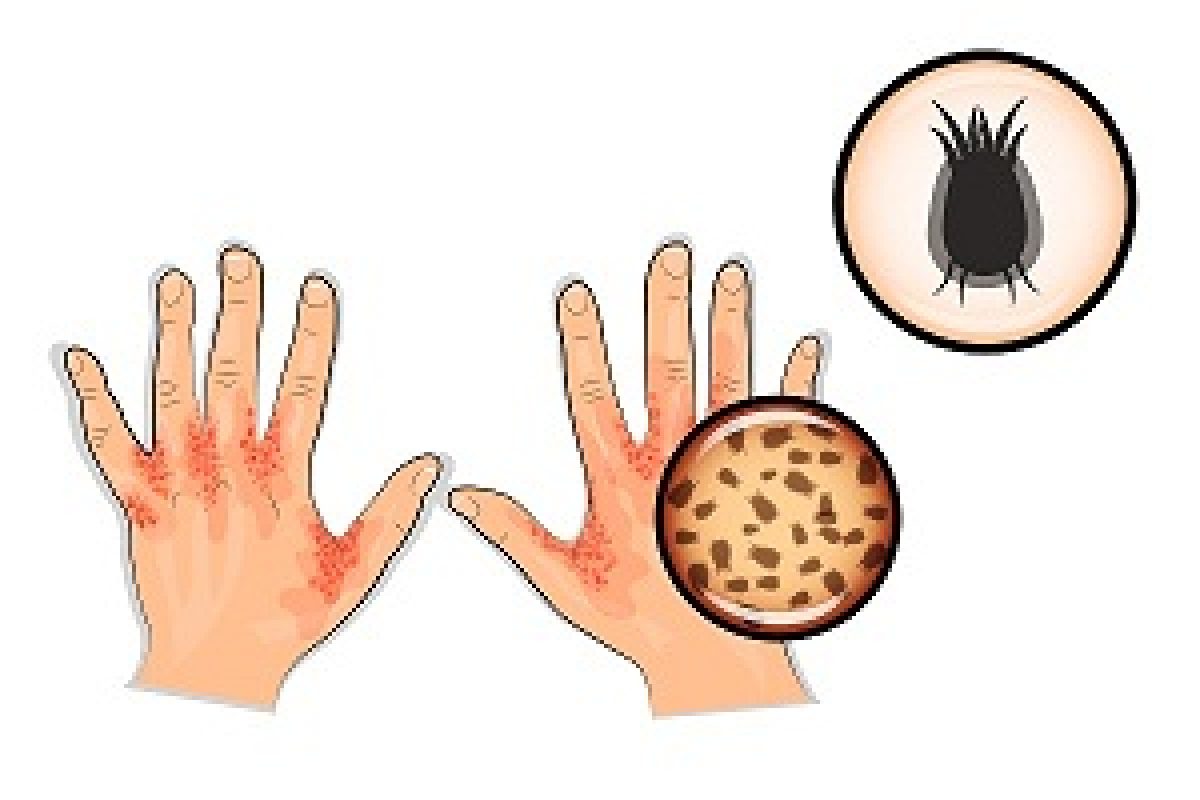What Does a Scabies Mite Bite Look Like - DiseaseFix