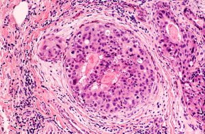 Breast cancer diagnosis through biopsy procedure