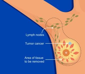 mastectomy