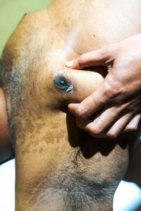 Male Breast Cancer