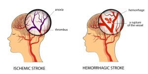 Ischemic vs hemorrhagic Stroke