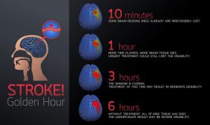 Time dependent effect of stroke