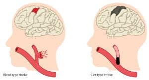 Two causes of stroke - bleed type stroke (hemorrhagic stroke) and clot type stroke (ischemic stroke)