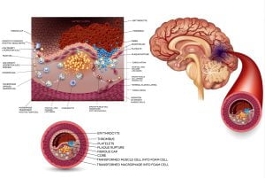 Ischemic stroke