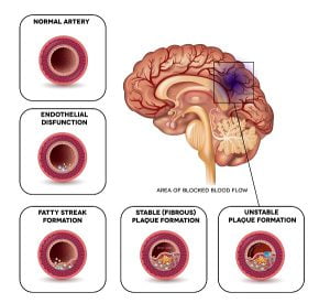 Stroke - Progression of atherosclerosis