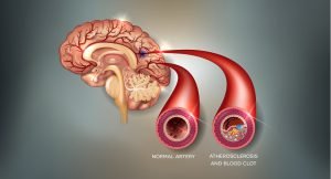 Normal cerebral artery vs artherosclerosis