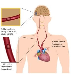 Atrial fibrillation and stroke