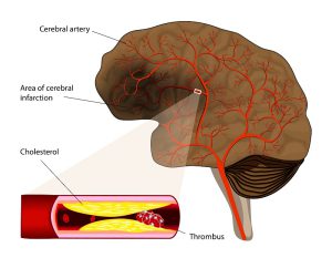 Cerebral infarction