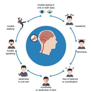 Stroke symptoms
