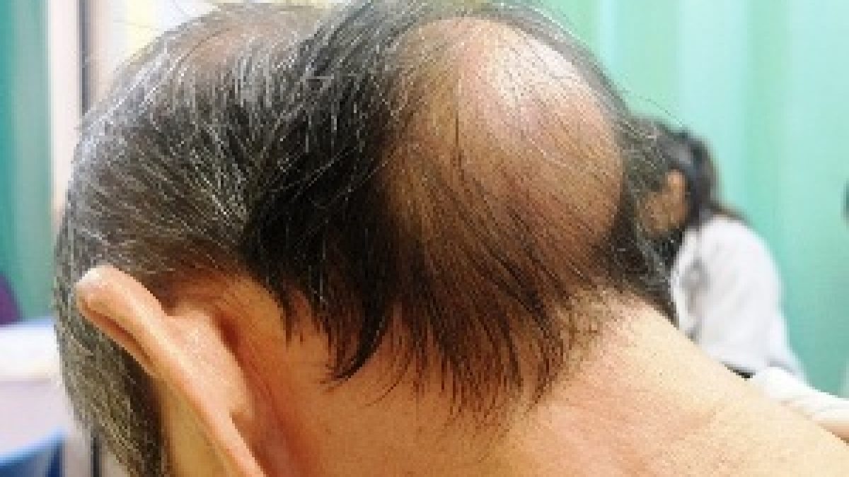 Lumps And Bumps On Head Causes Treatment Lumps And Bumps On Head Causes Treatment
