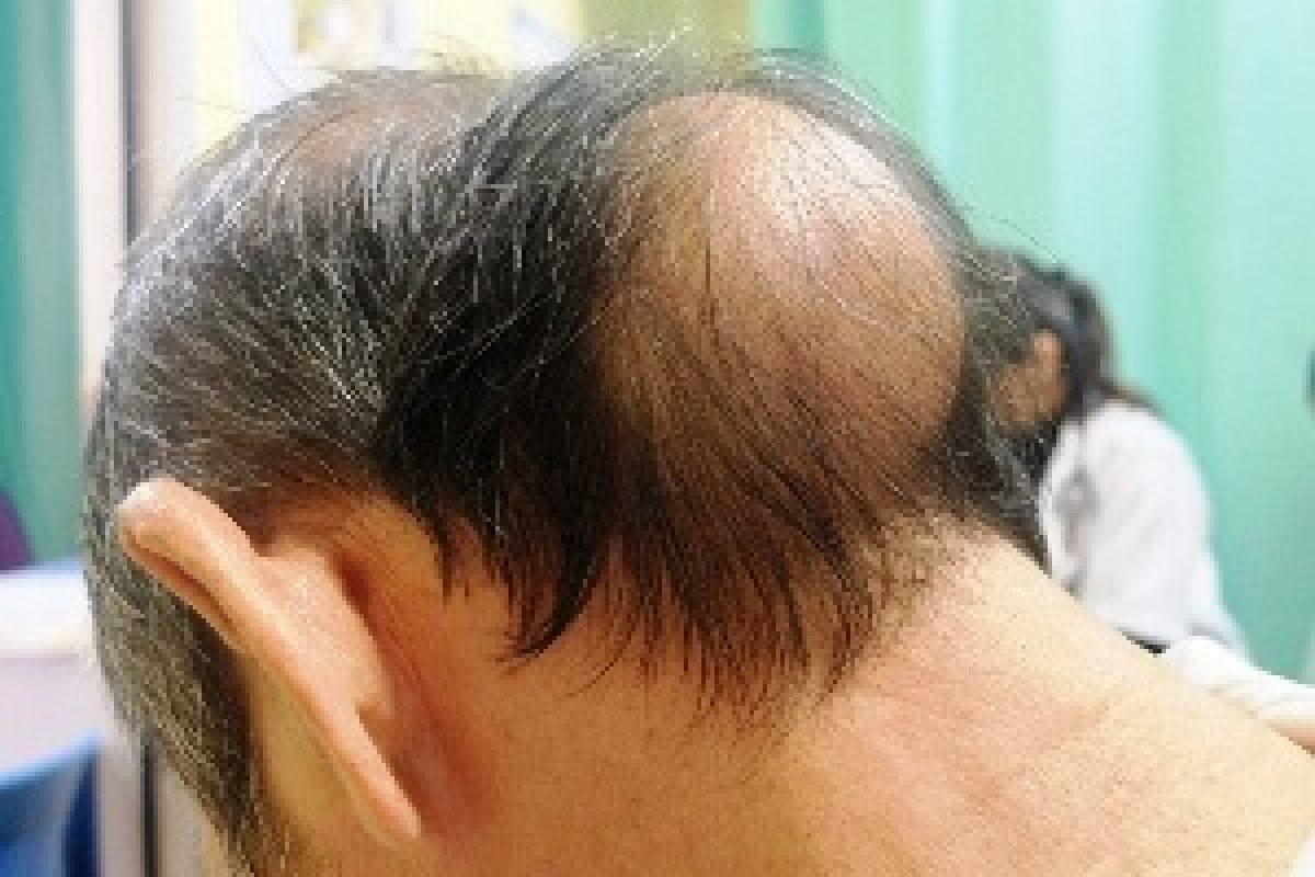Lumps And Bumps On Head Causes Treatment