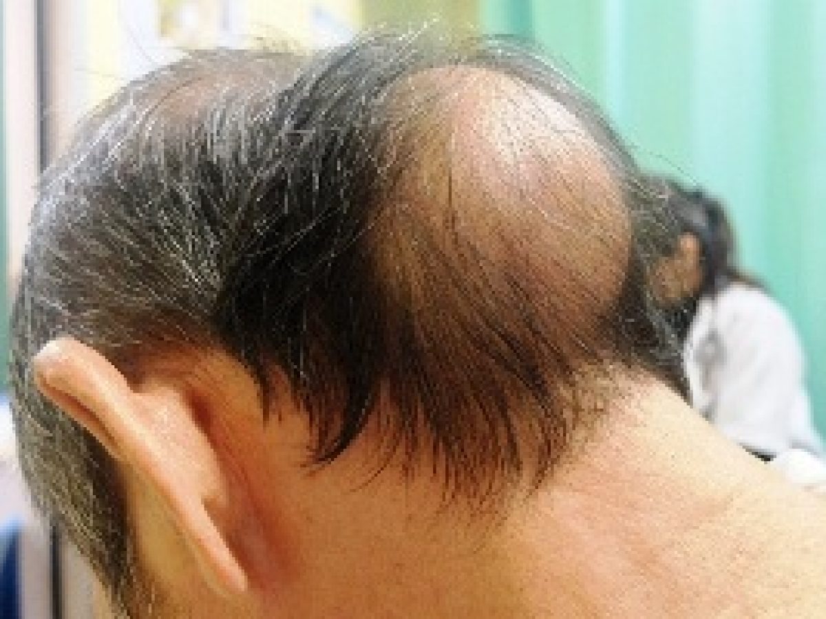 Lumps and Bumps on Head: Causes. Treatment