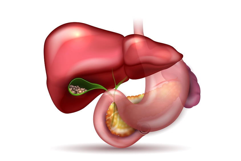 Gallstones in the Gallbladder