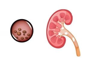 Passing a kidney stone