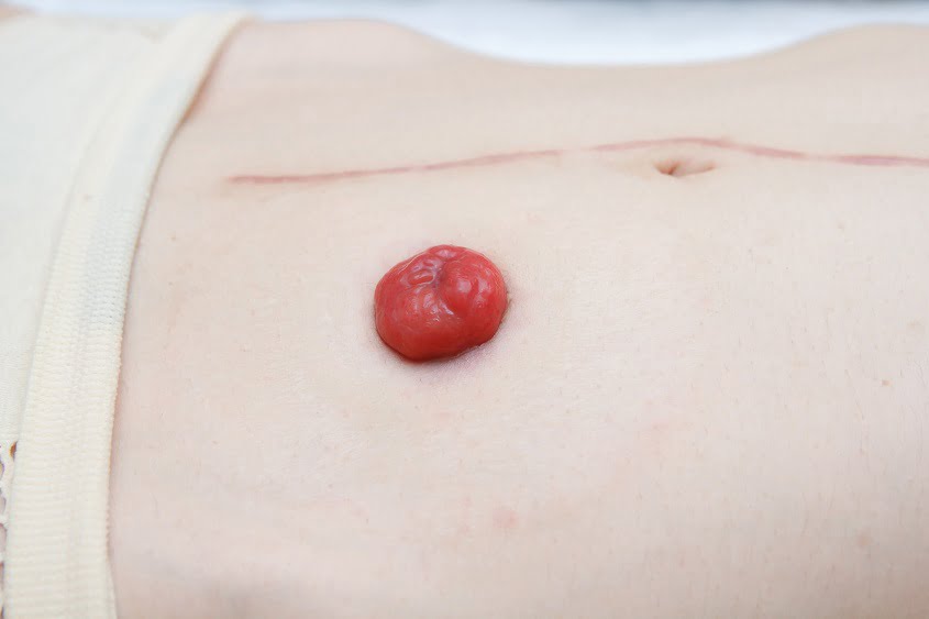 Stoma with long abdominal surgical scar