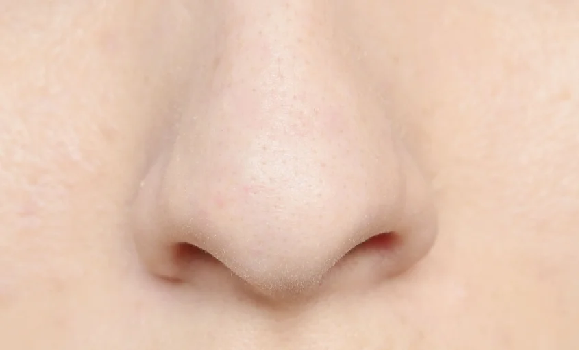 Nonsurgical nose job