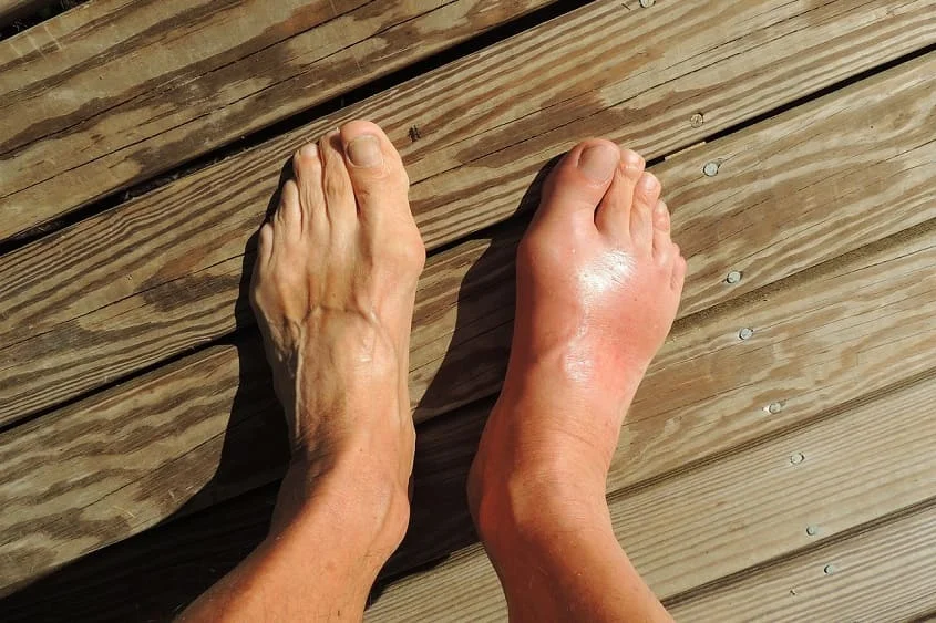gout icd-10